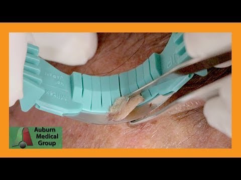 Basal Cell Carcinoma Shave Biopsy | Auburn Medical Group