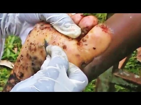 Handsome Brian's Feet, EATEN BY JIGGERS!