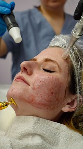 4 comments | #vampirefacial #prp #microneedling | Albany Cosmetic & Laser Centre | Facebook