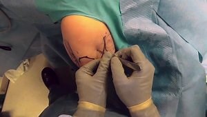 Arthroscopic Osteocapsular Arthroplasty