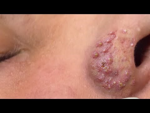 Suri Job 675: Awesome Blackheads Extraction