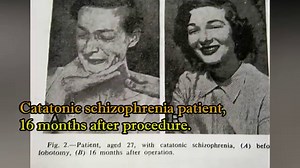 An ice pick to the brain: The horror of the frontal lobotomy