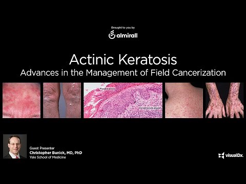 Actinic Keratosis: Advances in the Management of Field Cancerization