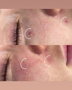 Before and After one treatment of Thread Vein Removal with Susan...