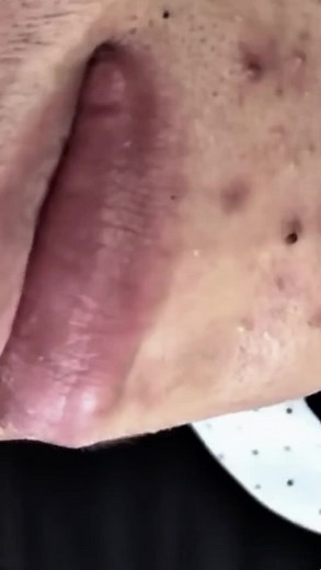 Squeezing Giant Comedones | Ultimate Pimple Popping