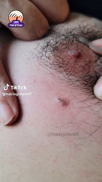 #tweezers #ingrownhairpull #ingrownhair #extraction #satisfyingvideo #satisfying