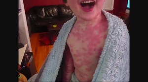 18K views · 220 reactions | Allergic reaction to penicillin | *Every day a medical case* | Facebook