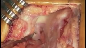 Unicompartmental Knee Arthroplasty