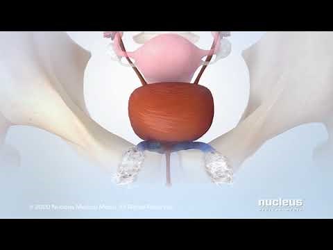 Tension free Vaginal Tape (TVT) Procedure