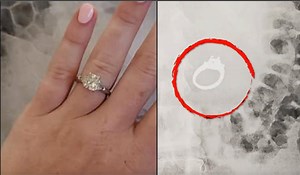 12K views · 172 reactions | These people swallowed some unusual objects. In 2018, a bride-to-be lost her engagement ring in one of the strangest places ever — her stomach. In 2017, a magic trick a 10-year-old girl attempted with coins led to a scare and a hospital visit. In 2018, a man ate a bacon-wrapped scallop at a party. Unknown to him, there was a broken toothpick lodged inside. | Inside Edition | Facebook