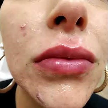 "WOW" Lip Augmentation with Juvederm Voluma, Long Lasting Lip Volume, Dr. Lebowitz, Long Island, NY