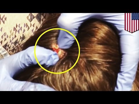 Cyst popping: Disgusting pus-filled sebaceous cyst on scalp popped and drained