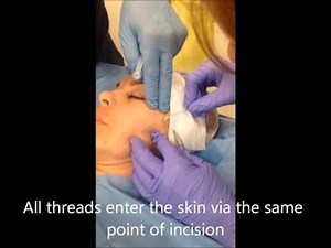 PDO Thread Lift with Cogs - Face