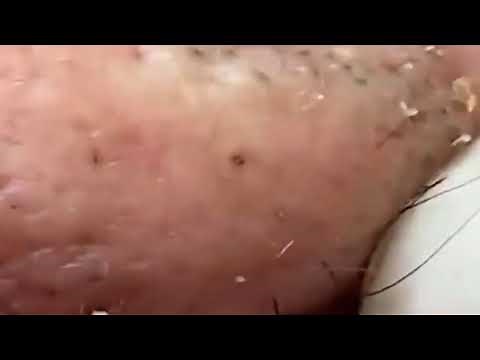 #36~Nose Blackheads • Blackheads 2021 New • Blackheads On Nose • Blackheads Nose