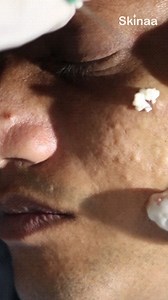 Struggling with cystic acne on your face? Discover effective solutions for treating facial cysts with advanced dermatological treatments at Skinaa Clinic. . . . . #skinaaclinic #skinaa #viral #acnetreatment #acneproblems #acnesolution | Skinaa - Skin, Laser, and Hair Transplant Clinic | Facebook