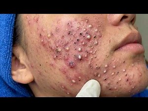 Blackhead Removal With Sac Dep Spa @325