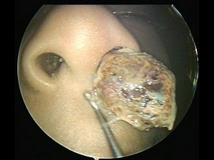LT sided unilateral nasal discharge 4 yr old kid