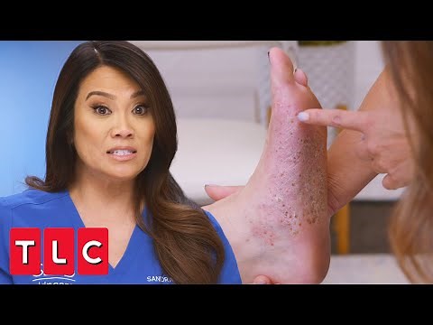 Karen's Feet Leave Dr. Lee Stumped | Dr. Pimple Popper