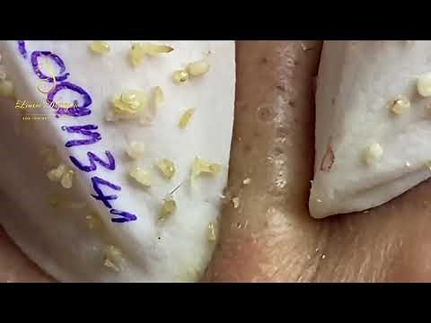 Remove blackheads in ears and Blackheads on face (341) | Loan Nguyen