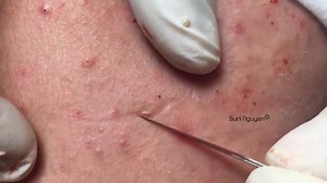 Suri Job 76: How to Get Rid of Blackheads & Whiteheads [LATEST VIDEOS] #BlackheadRemove #PimplePopping #Acne | Pimple Popper | Facebook