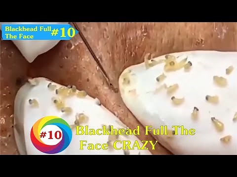 Pimples Blackheads All Over The Face And Pimples Around The Eyes | Blackhead Removal (# 10)