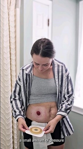 Tips for Getting Your Ostomy to Stick!