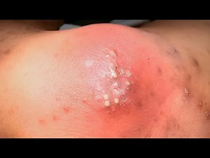 Multiloculated abscess drainage tutorial