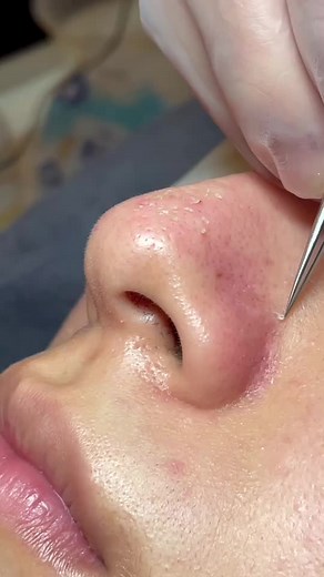 Nose Treatment: How to Extract Pore Impurities Safely