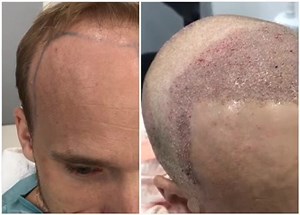 1.1K views | Happening Today: Follicular Unit Extraction (FUE), no...