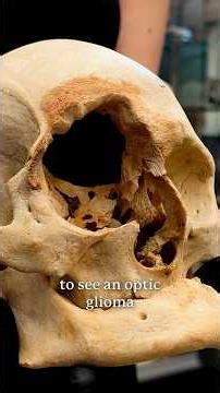 Rare Optic Glioma Destroyed This Skull | Neurofibromatosis Type 1