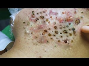 Extreme Cyst Explosion | Satisfying Pus Removal 💣 | Acne Scars Treatment