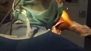 Calcaneum Fractures Treated by Open Reduction and Internal Fixation in Prone Distracted Position via Extensile Lateral Approach