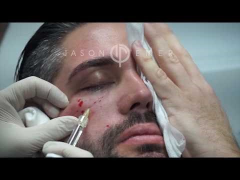 Belotero Fillers For Under Eye Hollows, Dark Circles And Eye Bags | Dark Circle Treatment Live