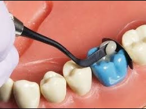 🦷 Composite Tray Setup with P.O Instructions (2019)