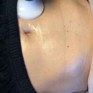 Happy to offer the #NuEra lymphatic drainage and skin tightening system! Helps to reduce the appearance of skin laxity and cellulite and helps create a more contoured appearance. Lumenis Aesthetic | Plastic Surgery Associates of Santa Rosa & Allegro MedSpa