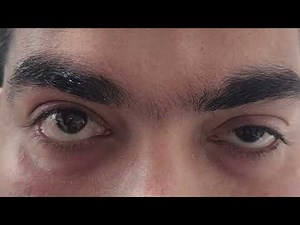 Lid Fatigability test for Ocular Myasthenia Gravis