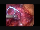 Laparoscopic Transperitoneal Pyelolithotomy and Pyeloplasty • Video • MEDtube.net