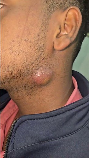 Neck large cyst
