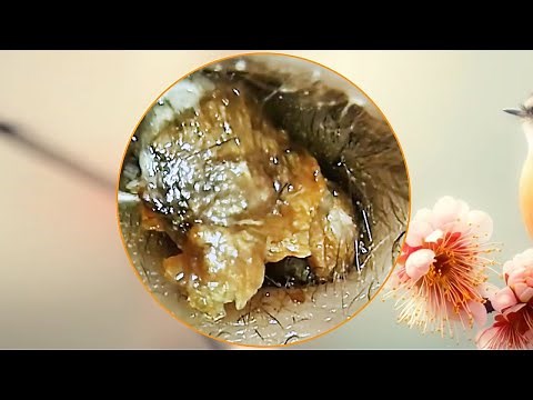 Ultimate Ear Cleaning | Big Ear Wax Removal + Relaxing Sounds