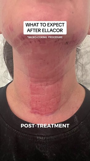 Day 0 - Day 10: here's what you can expect after an Ellacor procedure. ⏩ Our patient had this micro-coring procedure done on her neck/chin area to take care of sagging skin. Every patient heals at different rates so recovery time for Ellacor ranges from a few days to weeks, which can vary by patient and treatment settings. Ready to see the final result? Drop a 🌟 in the comments below for the reveal and we'll keep you updated! . . . #contourdermdoc #ellacor #saggingskin #jawline #jowls #jowling 