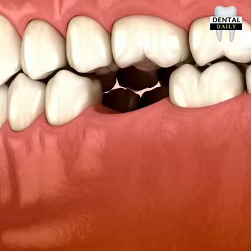 9.7K views · 203 reactions | Satisfying 3D Dental Animations | Most Common Dental Procedures Compilation | Dental Daily | Facebook
