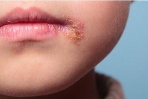 Epidermolysis bullosa and skin cancers: diagnosis and treatment