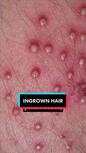 Ingrown Hair: What happens if they go Untreated? #ingrownhair #ingrownhairs #ingrownhairproblems #pseudofolliculitisbarbae #ingrowns #ingrownhairtreatment #ingrownhairproblems