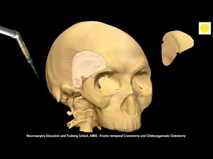 Neurosurgery 3D Animation Video : Frontotemporal Orbitozygomatic-FTOZ Approach