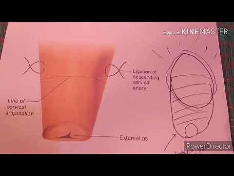 Manchester fothergills operation( Pelvic organ prolapse)