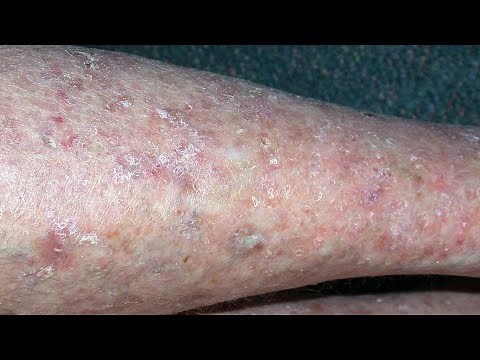 Cellulitis:- causes, symptoms, diagnosis and treatment