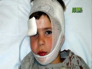 When Animals Strike - Coyote Attacks Boy