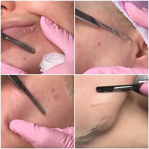 Pros and Cons of Dermaplaning you should know! | MetDaan Beauty