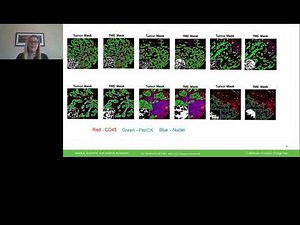 Assessing immune biomarkers of response to anthracyclines in breast cancer