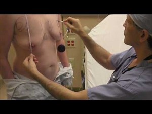 Dr. Daniel Medalie performs FtM top surgery (double incision mastectomy with nipple grafting)